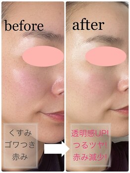 ロイ(Loy)/肌質改善メニュー♪(タップ)