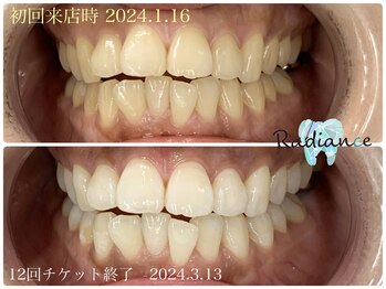 札幌セルフホワイトニング ラディアンス(Radiance)/歯のホワイトニング