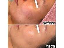 別人級の美肌へ。お肌悩みはなくなりどんどん美肌は更新していく