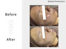 美活ラボ(美活LABO)/ハーブピーリング