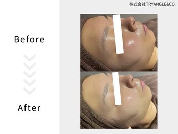 美活ラボ(美活LABO)/ハーブピーリング