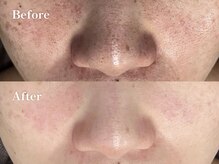 キーオブフェイス(Key of Face)/お悩み【毛穴の黒ずみ】