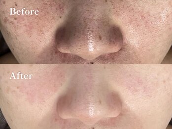 キーオブフェイス(Key of Face)/お悩み【毛穴の黒ずみ】