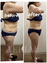 エアリアル 玉名店/脂肪冷却の変化！