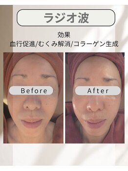 ワイズ(Y's)/ラジオ波