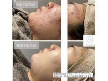 ラヴィオーラ 名駅(LaViora)/ダイヤモンドハーブピーリング