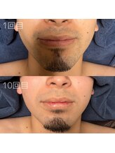 カナウ(KANAU)/ヒゲ脱毛（20代前半男性）