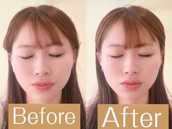 アカシア鍼灸整骨院の写真/季節の変わり目の肌トラブルには【美容鍼灸】血流改善・ターンオーバー促進！肌質改善ができる根本改善美容