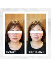 フローフシ∞/【小顔】20代女性症例写真