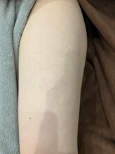 ムーンストーン(Moonstone)/高校生(上腕)２回目施術前