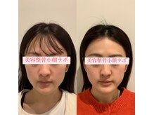 美容整骨小顔ラボ/小顔矯正ビフォーアフター