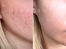 ウルリア(URURIA)/プラズマニア ニキビ改善症例