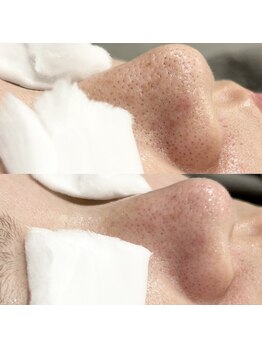 サロンアンドビューティ エス チャタン(Salon&Beauty S chatan)/毛穴洗浄ピーリング