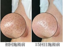 シエール 調布(Ci'aile)の雰囲気（【驚愕の最新毛穴ケア】黒ずみ毛穴・ざらつき・皮脂/角栓詰まり）