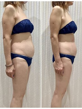 エスアール アミティ(SR Amity)/インディバ/お腹・背中・腰・肩