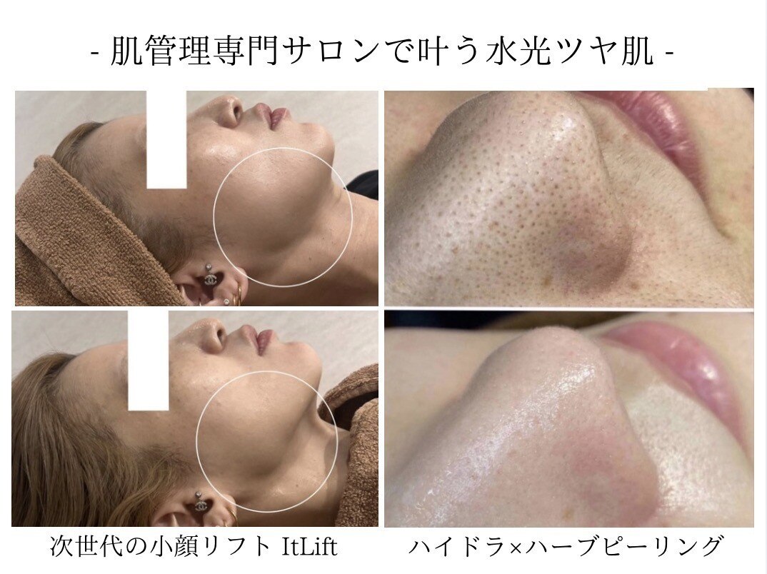サミット 超音波＆EMS美容器　リリーボックスLILYBOX■357,000円 リリー 一宮店(Lily)｜ホットペッパービューティー
