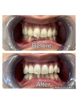 プルーラントエステ キョウト ビジョーラ(PullulantEsthe Kyoto×BEJORA)/ホワイトニング効果