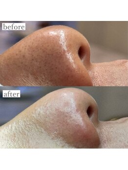 ライカブルー(RaicA BluE)/施術写真　before-after