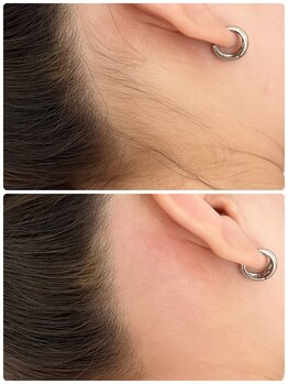 リアン(Rian)/うなじ&フェイスライン脱毛