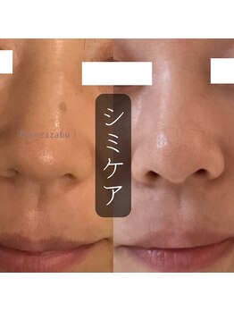 ディオーネ 麻布十番(Dione)/【シミケア】