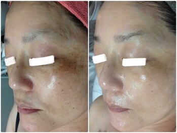 ルノン(LUNON)/ビフォーアフター集