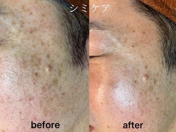 カピリナ(KA PILINA)/シミケアエステ