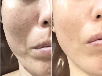 ラフレ(Rafre)/肌質改善☆シリカピーリング