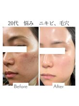 ファニービー 吹田店/20代 ニキビ 3ヶ月で改善