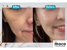 ニコ(nico)の雰囲気（ナチュラルハーブピーリングmoco）