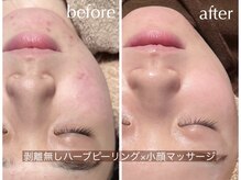 フラーブ(Flourb)の雰囲気（『ハーブピーリング×小顔マッサージ』セットになって血行促進◎）