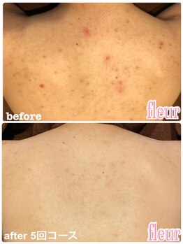 フルール(Fleur)/■背中トリートメント■