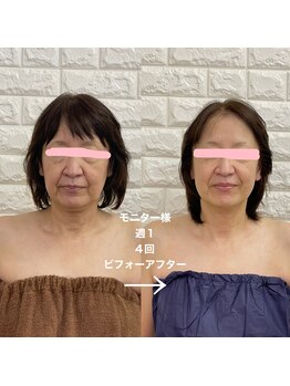 エステサロン クレイドルフェザー/ウィンバックフェイシャル