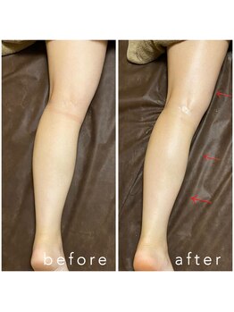 美フレッシュ 銀座店(美FRESH)/ハイパーナイフ施術10分効果