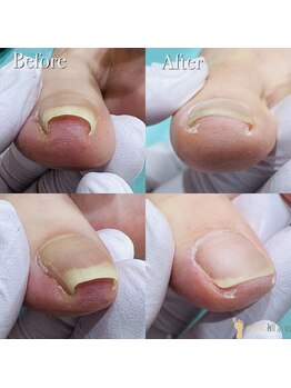 巻き爪補正店 湘南辻堂店/巻き爪・施術例