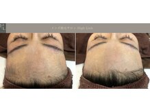 ハイリンク(High Link)/《おでこ脱毛》before→after