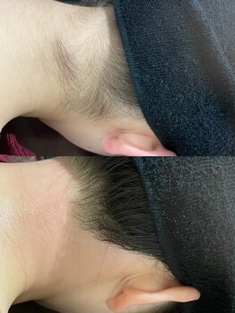 エレナビューティー(Elena Beauty)/うなじW脱毛