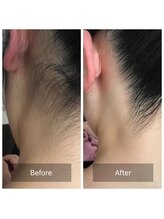 マジュエル majewel/ladies全身脱毛