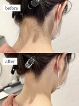 ワイズサロン(Y's salon)/うなじ脱毛の症例