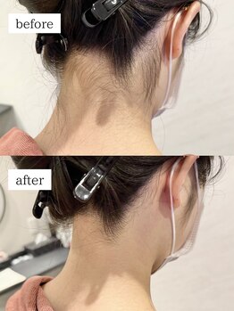 ワイズサロン(Y's salon)/うなじ脱毛の症例