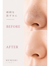 メモリ&nbsp;ビフォー アフター