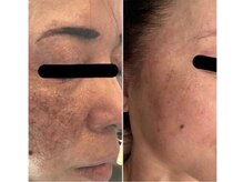 クラティス 塩尻店(CRATIS)/プロセルセラピー