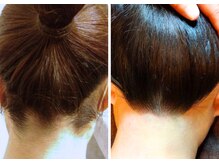 トリニティスペース(TrinitySpace)/浴衣、ウエディングにうなじ脱毛