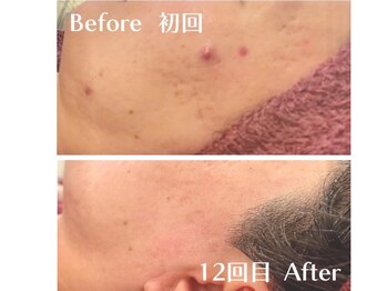 ヒーリングハーツ(Healing Hearts)/肌悩みの根本改善!/清水町/