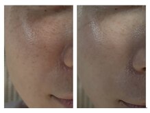 ザ ワン(THE ONE)/【生ビタミンC/幹細胞導入】効果