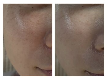 ザ ワン(THE ONE)/【生ビタミンC/幹細胞導入】効果