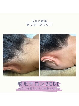 ベベ(Bebe)/うなじ脱毛♪