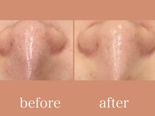 エピラックス(epilax)/ハイドラフェイシャル