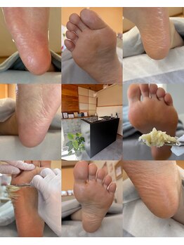 フットミー(foot mii)/長年の頑固な角質も