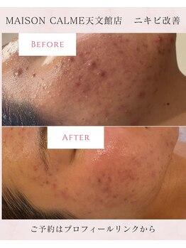 メゾン カルム 天文館店(MAISON CALME)/肌質改善　途中経過