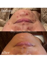 エピロマ(EPILOMA)/鹿児島市/宇宿/肌質改善